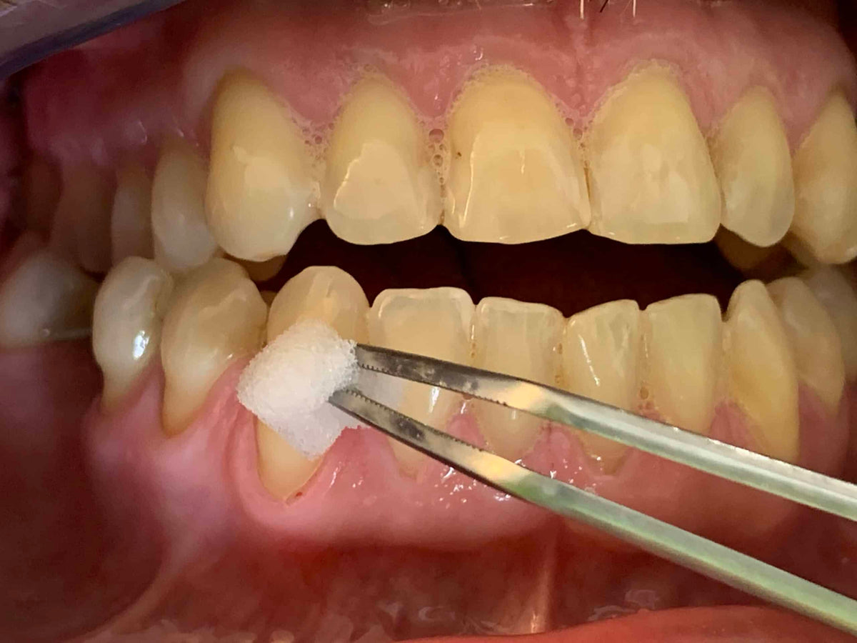 Humanchemie Tiefenfluorid application – applying the solution to tooth necks with a soaked cotton pellet