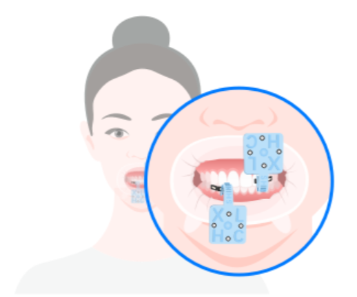 Shining 3D MetiSmile – Jaw Motion Tracking Accessories